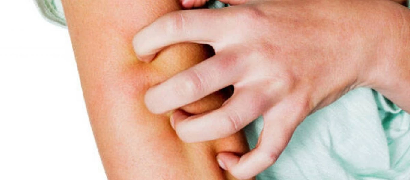 Φαγούρα: Που οφείλεται και πως αντιμετωπίζεται;